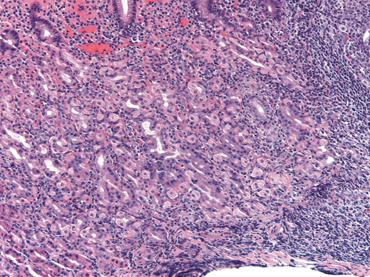 gastric erosion, H&E, 10x, atypical large cell infiltrate within gastric mucosa